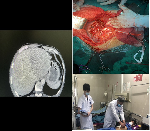 Phẫu thuật cắt gan không chảy máu điều trị ung thư gan tại Bệnh viện Đa khoa tỉnh Ninh Bình.